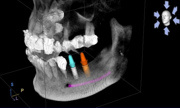 3D-Planung Implantat2 3D-Planung Implantat2