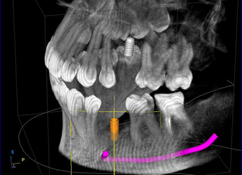 3D-Planung Implantat_web 3D-Planung Implantat_web